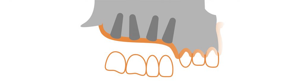 module3-traitement-maxillaire-sans-greffe-sapo-implant-2